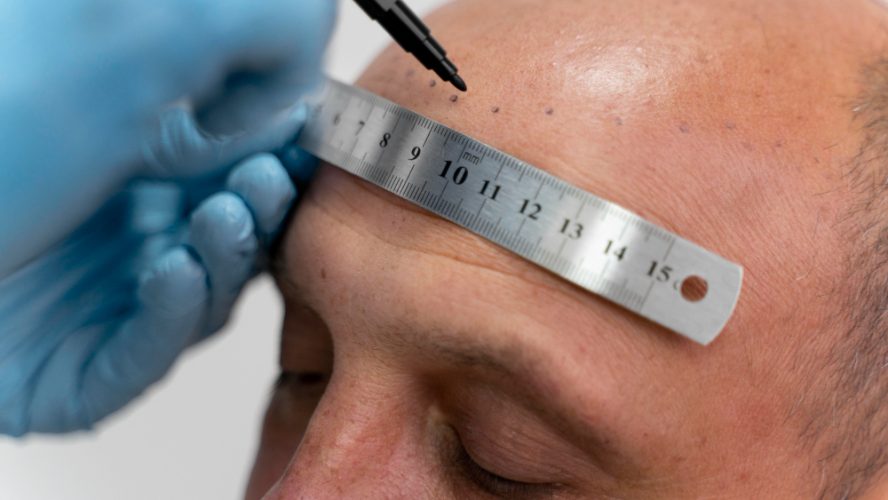 La Tricopigmentazione: Innovazione e Soluzioni per la Perdita dei Capelli